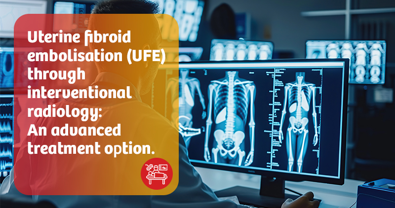 Uterine fibroid embolisation (UFE) through interventional radiology 